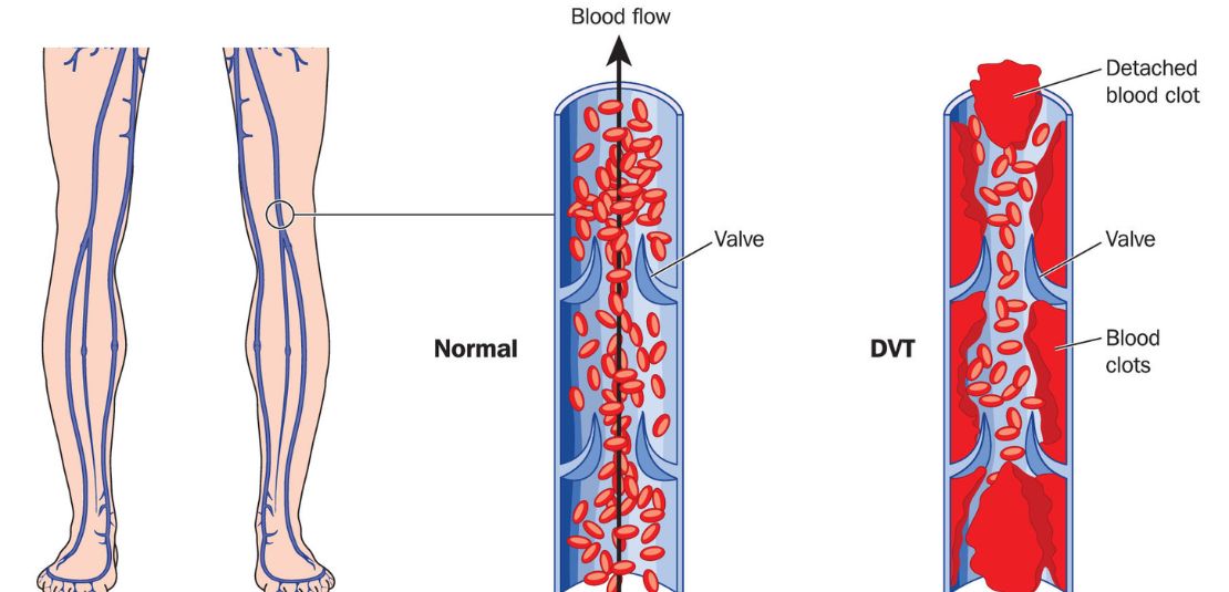 Preventing Deep Vein Thrombosis DVT in ICU Patients 